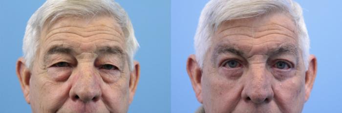 Before & After Blepharoplasty (Lower, Under Eyes) Case 156 View #2 View in West Des Moines & Ames, IA