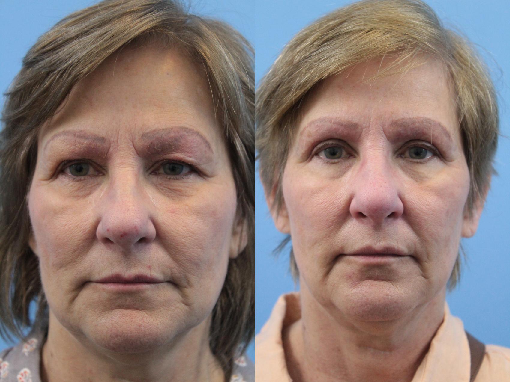 Before & After Blepharoplasty (Upper Eyelid Lift) Case 159 View #1 View in West Des Moines & Ames, IA
