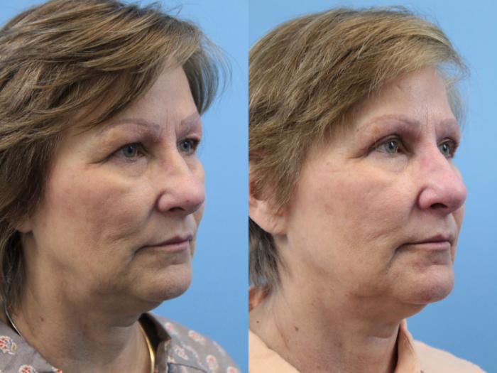 Before & After Blepharoplasty (Upper Eyelid Lift) Case 159 View #2 View in West Des Moines & Ames, IA
