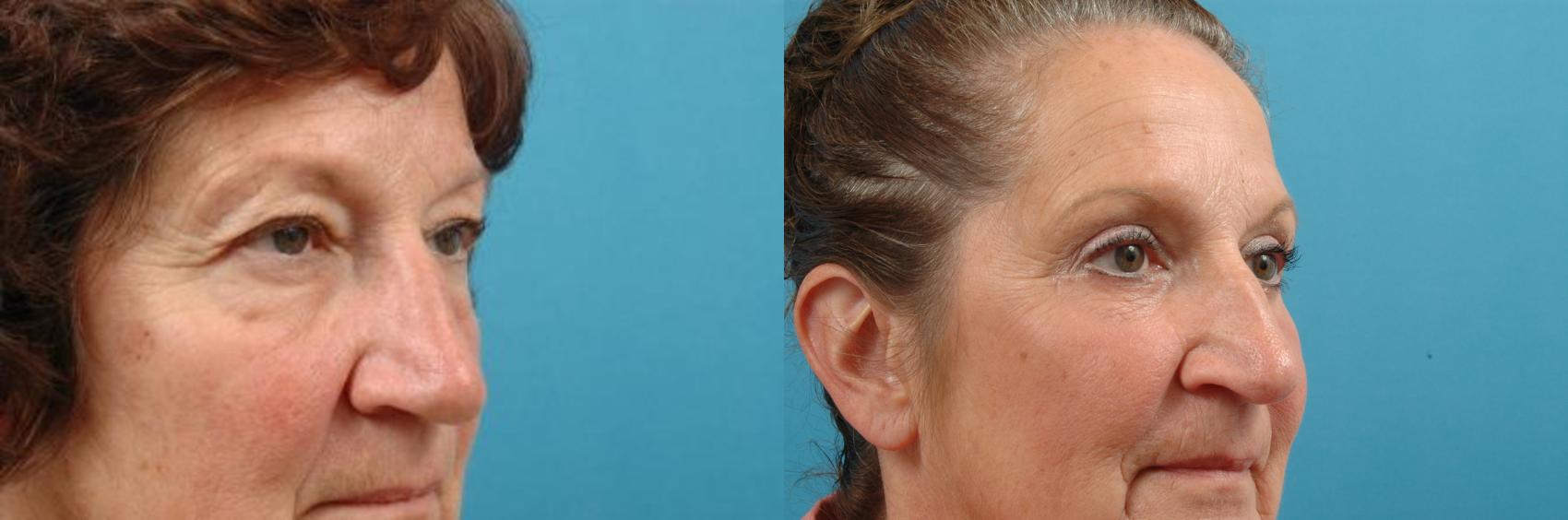 Before & After Blepharoplasty (Upper Eyelid Lift) Case 16 View #1 View in West Des Moines & Ames, IA