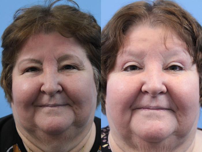 Before & After Blepharoplasty (Upper Eyelid Lift) Case 163 View #1 View in West Des Moines & Ames, IA
