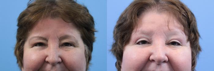 Before & After Blepharoplasty (Upper Eyelid Lift) Case 163 View #2 View in West Des Moines & Ames, IA