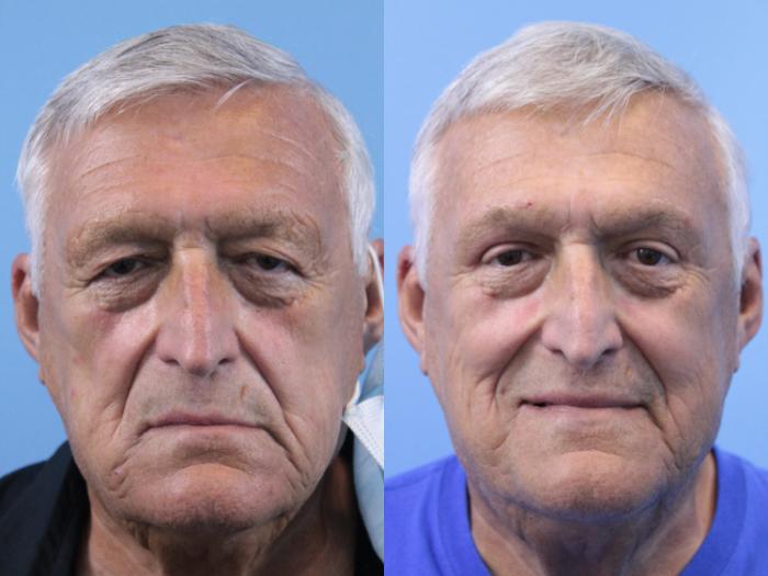 Before & After Blepharoplasty (Upper Eyelid Lift) Case 165 View #1 View in West Des Moines & Ames, IA