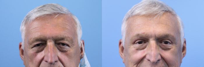 Before & After Blepharoplasty (Upper Eyelid Lift) Case 165 View #2 View in West Des Moines & Ames, IA