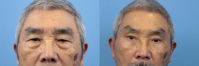 Before & After Blepharoplasty (Upper Eyelid Lift) Case 173 View #2 View in West Des Moines & Ames, IA