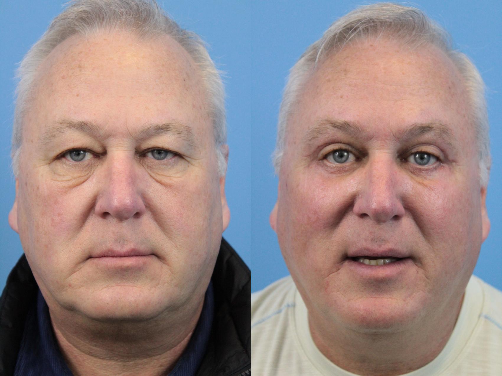 Before & After Blepharoplasty (Upper Eyelid Lift) Case 178 View #1 View in West Des Moines & Ames, IA
