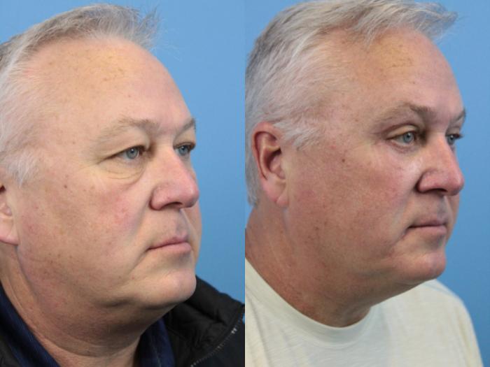Before & After Blepharoplasty (Upper Eyelid Lift) Case 178 View #2 View in West Des Moines & Ames, IA