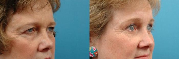 Before & After Blepharoplasty (Lower, Under Eyes) Case 18 View #1 View in West Des Moines, IA