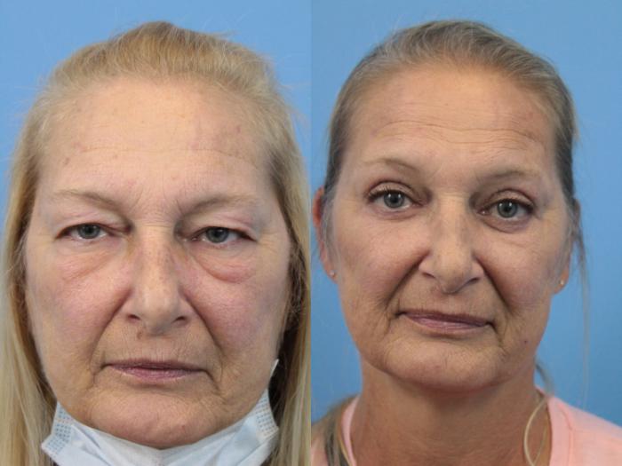 Before & After Blepharoplasty (Lower, Under Eyes) Case 186 View #1 View in West Des Moines, IA