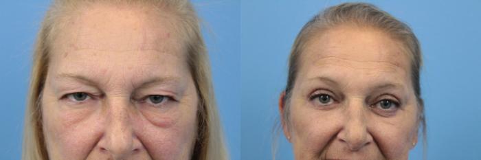 Before & After Blepharoplasty (Lower, Under Eyes) Case 186 View #2 View in West Des Moines & Ames, IA