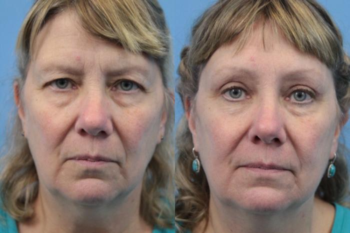 Before & After Blepharoplasty (Upper Eyelid Lift) Case 193 Front View in West Des Moines & Ames, IA