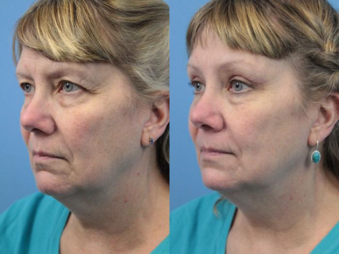 Before & After Blepharoplasty (Upper Eyelid Lift) Case 193 Left Oblique View in West Des Moines & Ames, IA