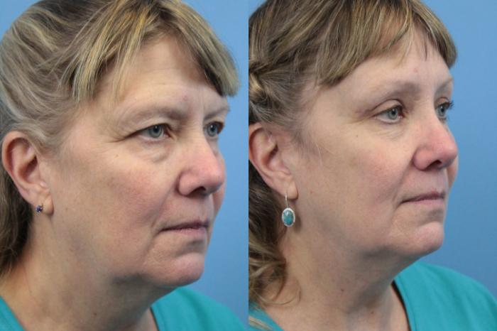 Before & After Blepharoplasty (Upper Eyelid Lift) Case 193 Right Oblique View in West Des Moines & Ames, IA