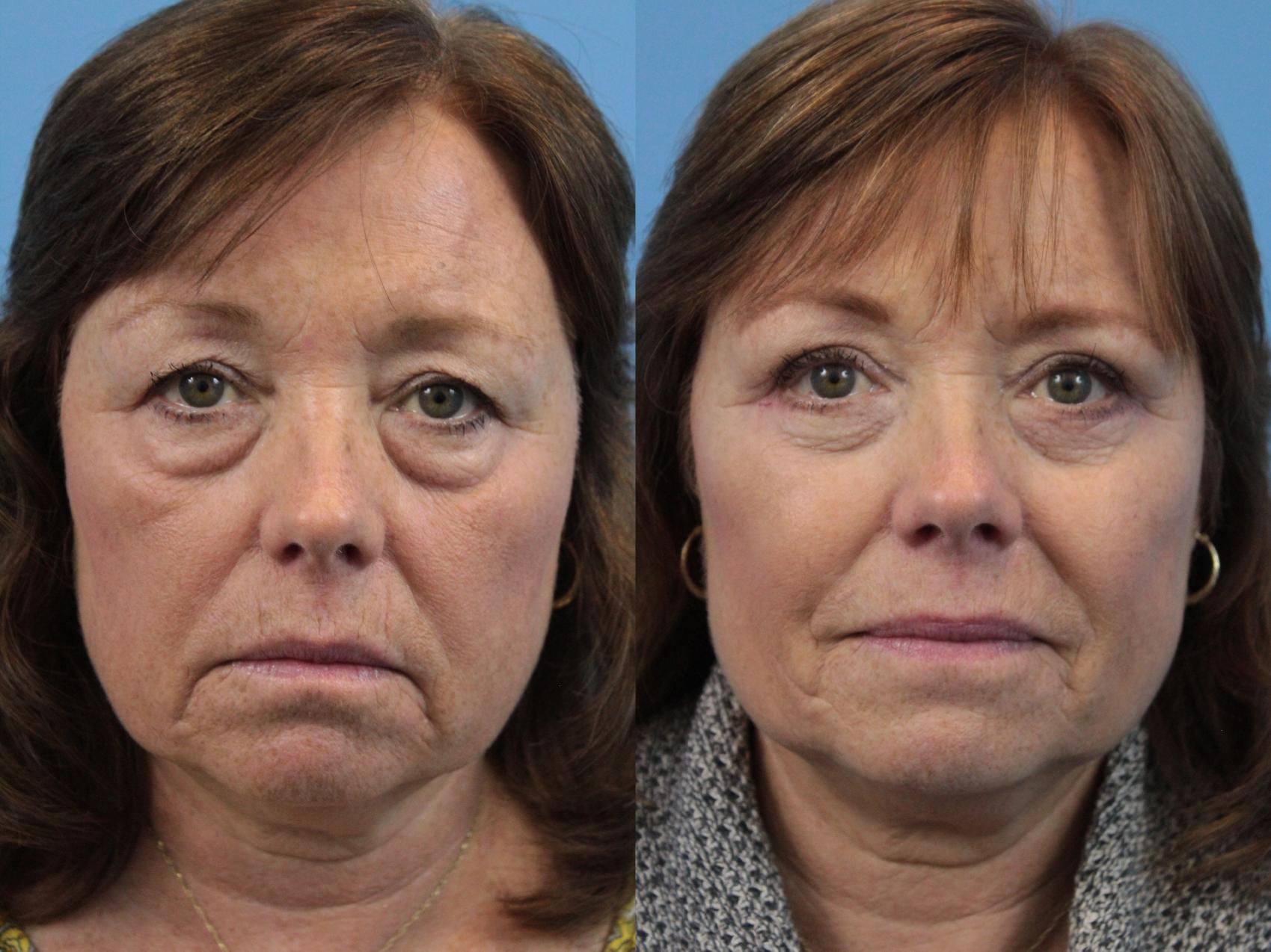 Before & After Blepharoplasty (Lower, Under Eyes) Case 194 Front View in West Des Moines & Ames, IA