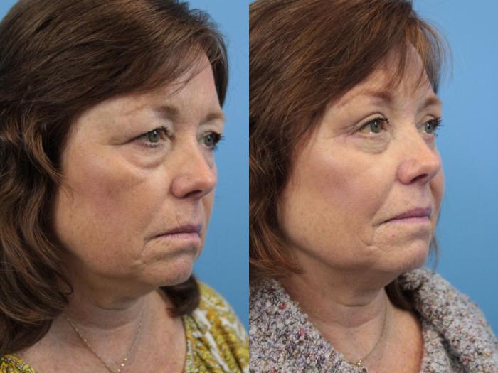 Before & After Blepharoplasty (Lower, Under Eyes) Case 194 Right Oblique View in West Des Moines & Ames, IA