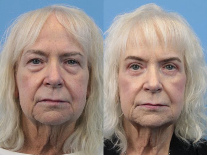 Before & After Blepharoplasty (Lower, Under Eyes) Case 195 Front View in West Des Moines, IA