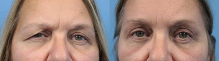Before & After Blepharoplasty (Upper Eyelid Lift) Case 197 Front View in West Des Moines & Ames, IA
