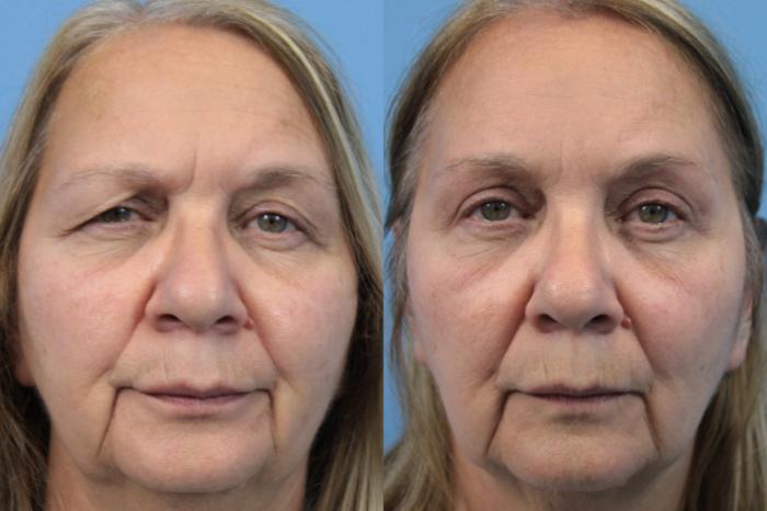 Before & After Brow Lift Case 197 Full Face Front View in West Des Moines & Ames, IA