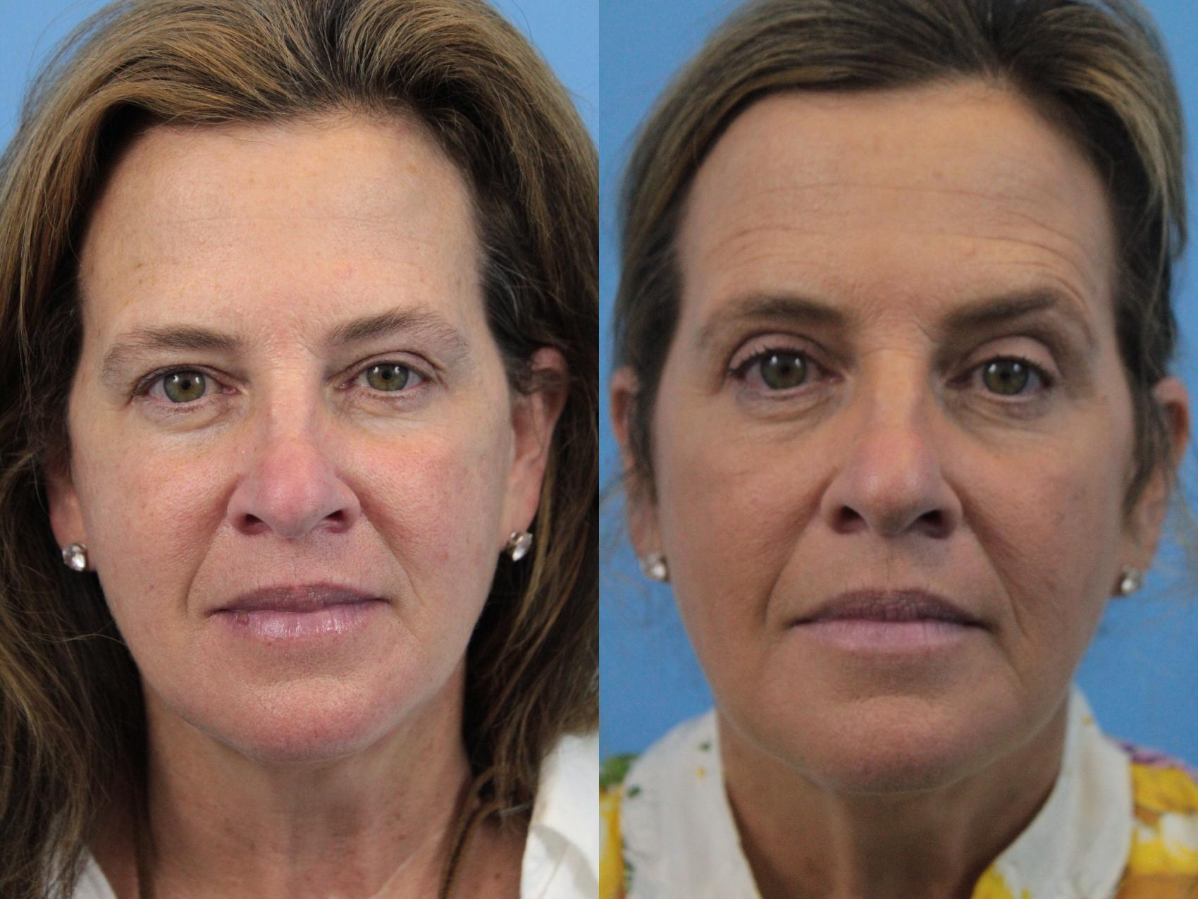 Before & After Blepharoplasty (Upper Eyelid Lift) Case 217 Front View in West Des Moines & Ames, IA