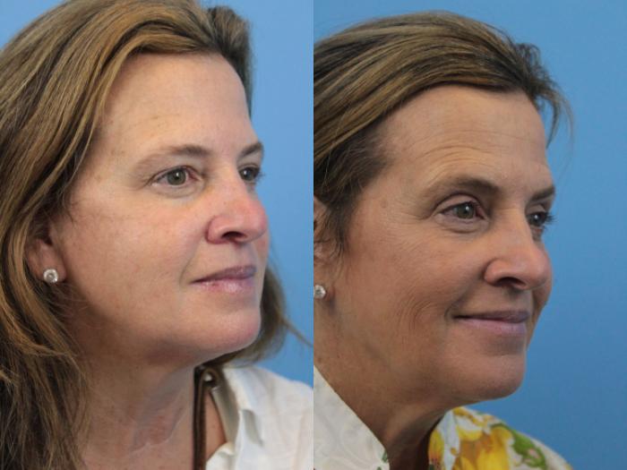 Before & After Blepharoplasty (Upper Eyelid Lift) Case 217 Right Oblique View in West Des Moines & Ames, IA