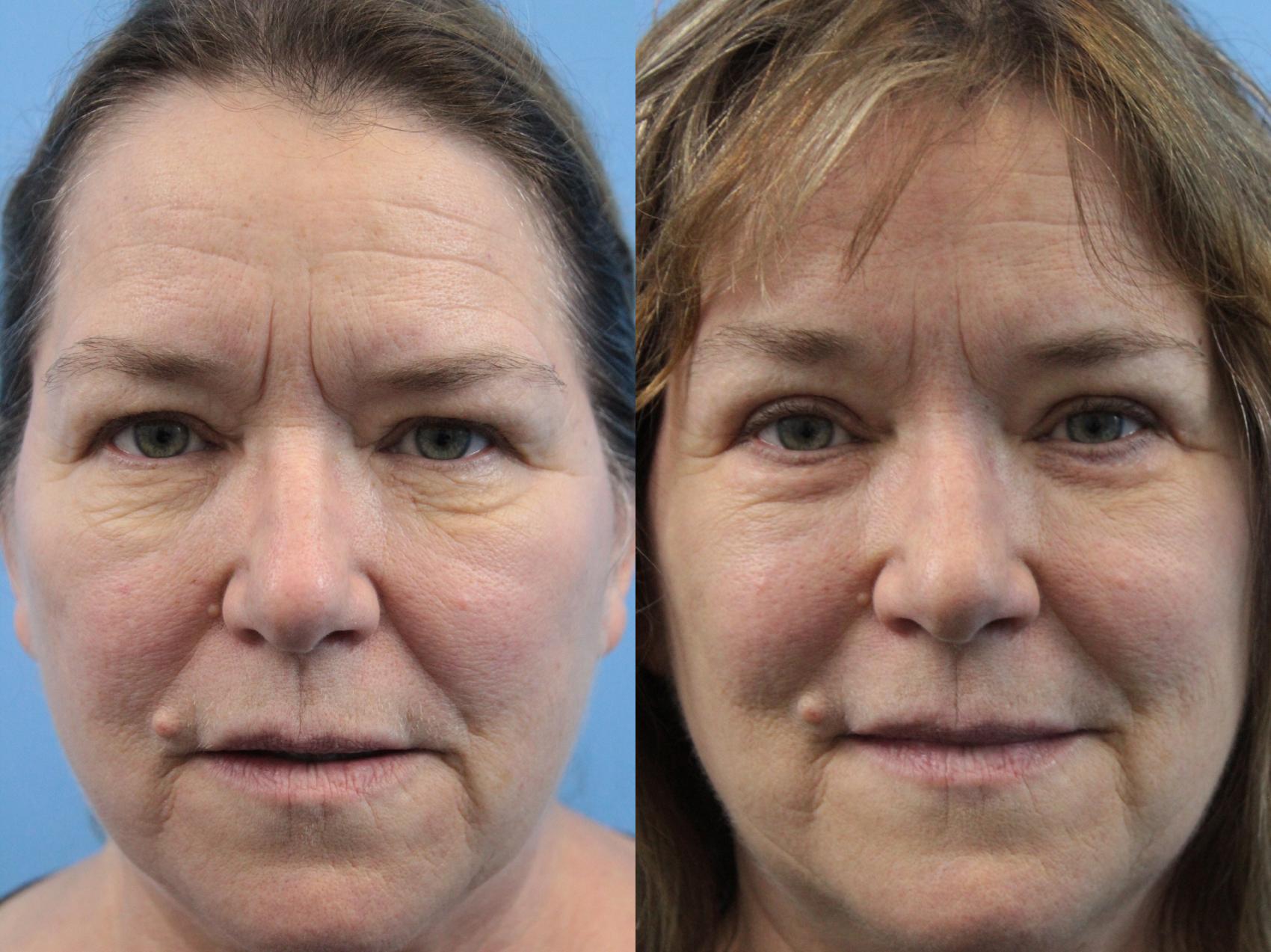 Before & After Blepharoplasty (Upper Eyelid Lift) Case 229 Front View in West Des Moines & Ames, IA
