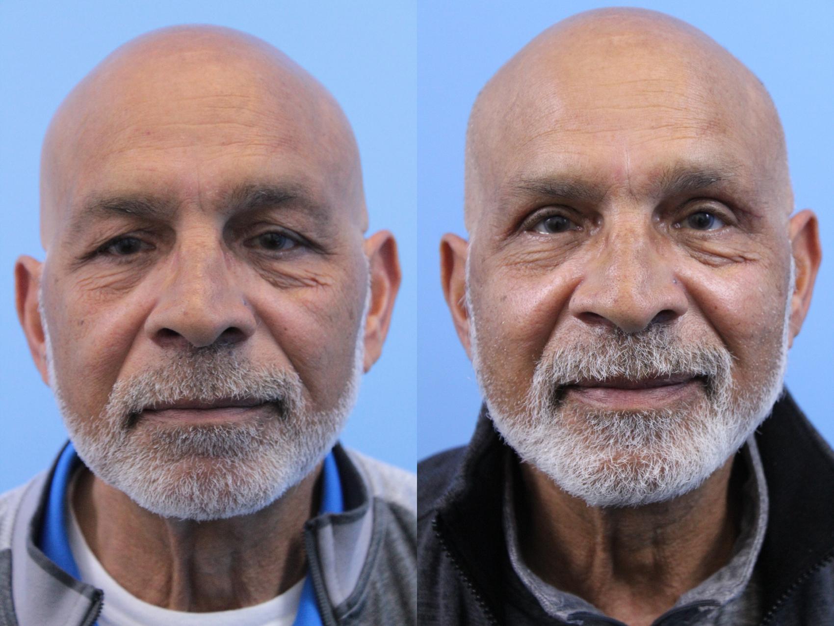 Before & After Blepharoplasty (Upper Eyelid Lift) Case 230 Front View in West Des Moines & Ames, IA