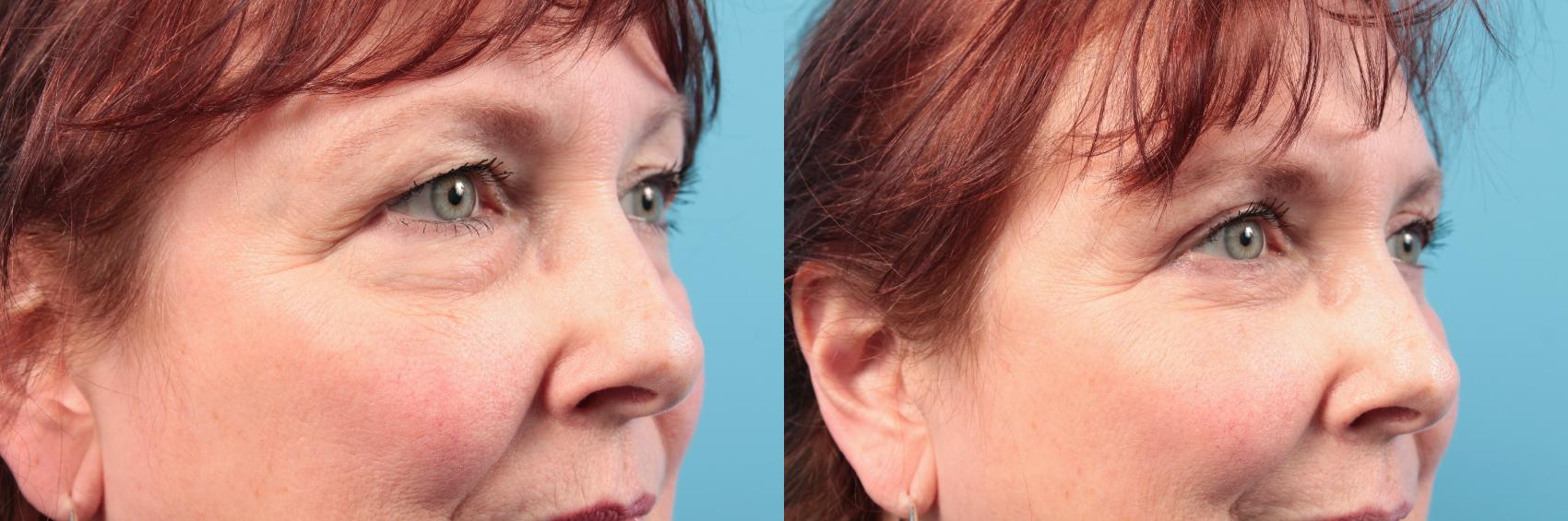 Before & After Blepharoplasty (Lower, Under Eyes) Case 24 Right Oblique View in West Des Moines & Ames, IA