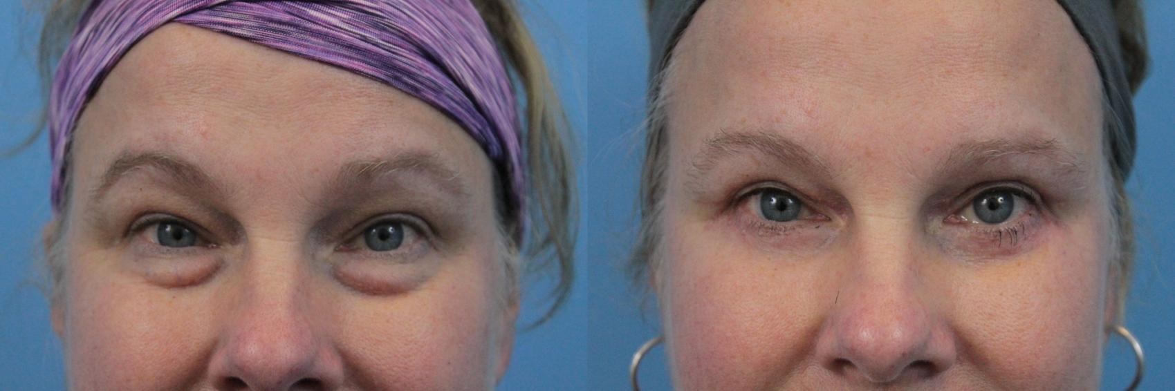 Before & After Blepharoplasty (Lower, Under Eyes) Case 279 Front View in West Des Moines & Ames, IA