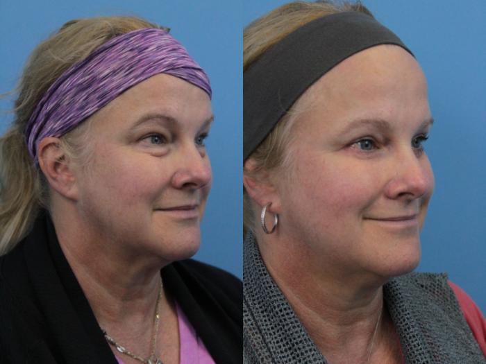 Before & After Blepharoplasty (Lower, Under Eyes) Case 279 Right Oblique View in West Des Moines & Ames, IA