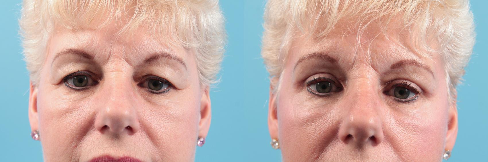 Before & After Blepharoplasty (Upper Eyelid Lift) Case 30 View #1 View in West Des Moines & Ames, IA