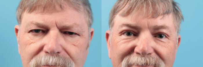 Before & After Blepharoplasty (Upper Eyelid Lift) Case 31 View #1 View in West Des Moines & Ames, IA