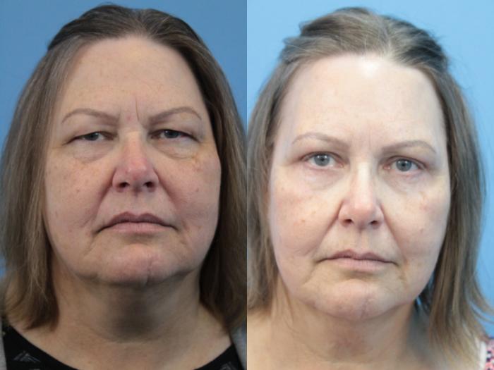Before & After Blepharoplasty (Lower, Under Eyes) Case 349 Front View in West Des Moines & Ames, IA