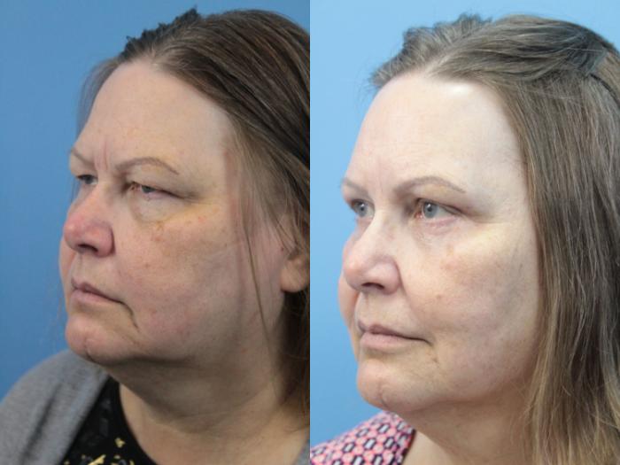 Before & After Blepharoplasty (Lower, Under Eyes) Case 349 Left Oblique View in West Des Moines & Ames, IA