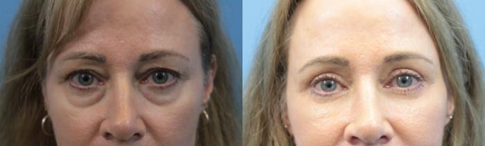Before & After Blepharoplasty (Upper Eyelid Lift) Case 367 Front- close up View in West Des Moines & Ames, IA