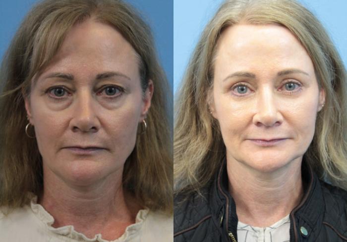 Before & After Blepharoplasty (Lower, Under Eyes) Case 367 Front View in West Des Moines & Ames, IA