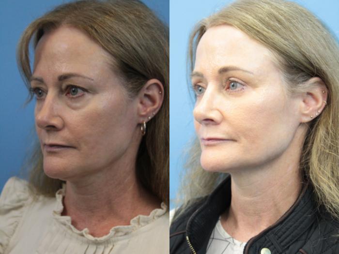 Before & After Blepharoplasty (Lower, Under Eyes) Case 367 Left Oblique View in West Des Moines & Ames, IA