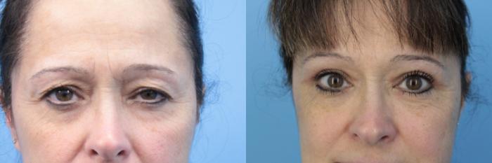 Before & After Blepharoplasty (Upper Eyelid Lift) Case 382 Front View in West Des Moines & Ames, IA