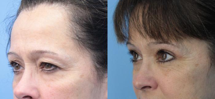 Before & After Blepharoplasty (Upper Eyelid Lift) Case 382 Left Oblique View in West Des Moines & Ames, IA