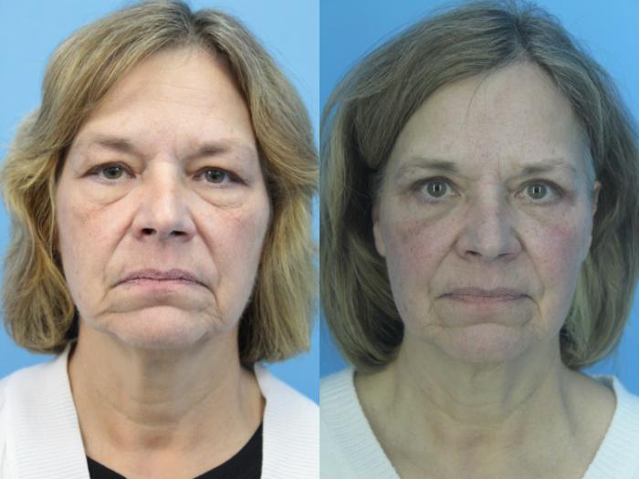 Before & After Blepharoplasty (Upper Eyelid Lift) Case 410 Front View in West Des Moines & Ames, IA