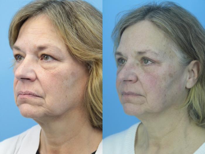 Before & After Blepharoplasty (Lower, Under Eyes) Case 410 Left Oblique View in West Des Moines & Ames, IA
