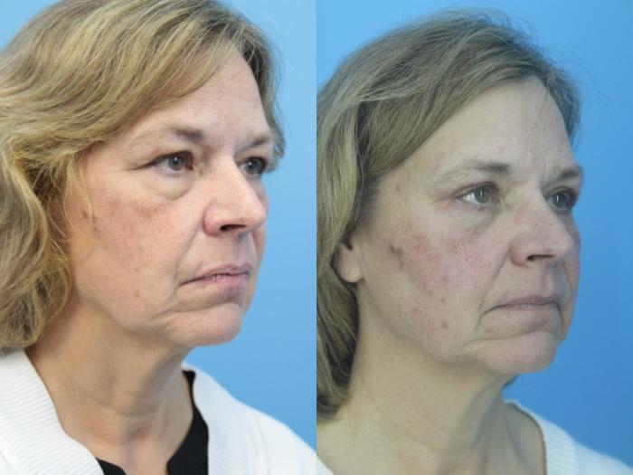 Before & After Blepharoplasty (Lower, Under Eyes) Case 410 Right Oblique View in West Des Moines & Ames, IA