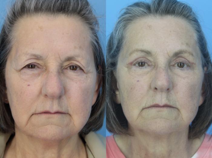 Before & After Blepharoplasty (Upper Eyelid Lift) Case 424 Front View in West Des Moines & Ames, IA