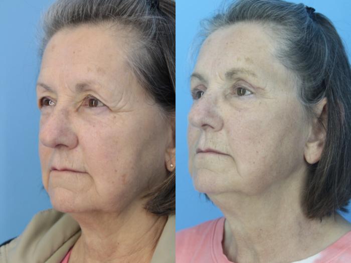 Before & After Blepharoplasty (Upper Eyelid Lift) Case 424 Left Oblique View in West Des Moines & Ames, IA