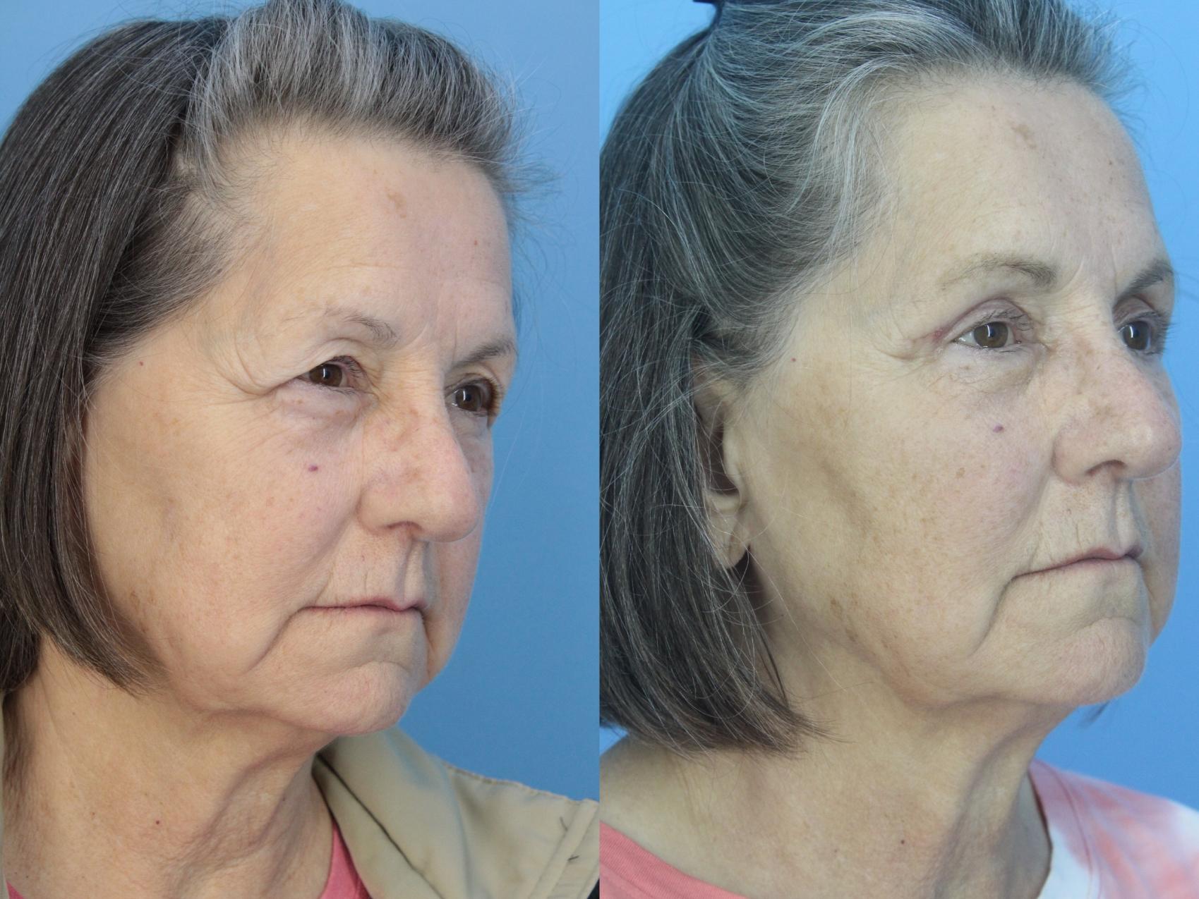 Blepharoplasty (Upper Eyelid Lift) Before and After Pictures Case 424 ...