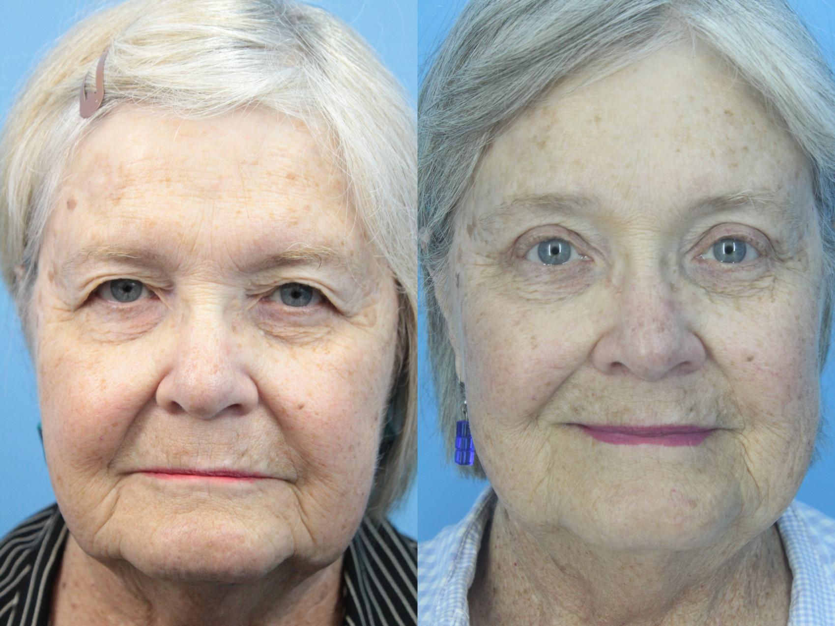 Before & After Brow Lift Case 425 Front View in West Des Moines & Ames, IA