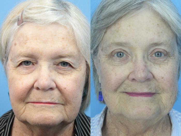 Before & After Blepharoplasty (Upper Eyelid Lift) Case 425 Front View in West Des Moines & Ames, IA