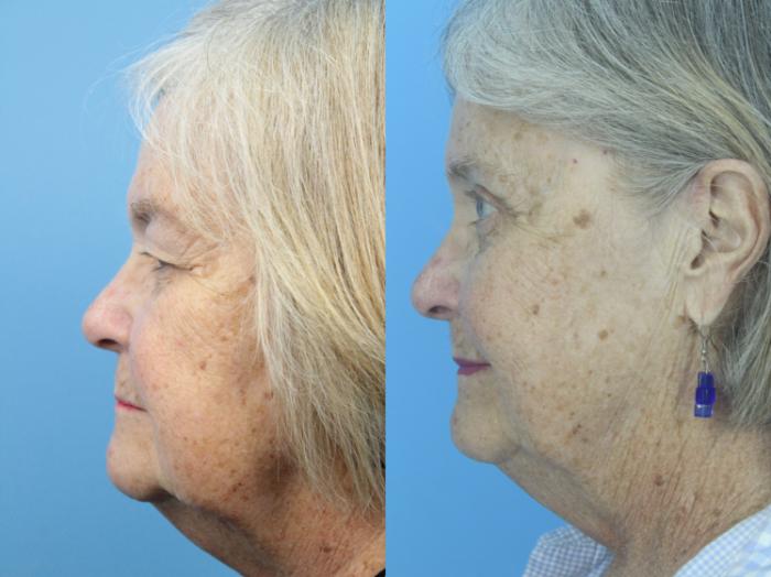 Before & After Blepharoplasty (Upper Eyelid Lift) Case 425 Left Side View in West Des Moines & Ames, IA