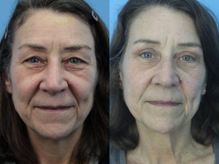 Before & After Blepharoplasty (Upper Eyelid Lift) Case 426 Front View in West Des Moines & Ames, IA