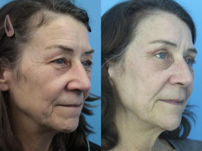 Before & After Blepharoplasty (Upper Eyelid Lift) Case 426 Right Oblique View in West Des Moines & Ames, IA