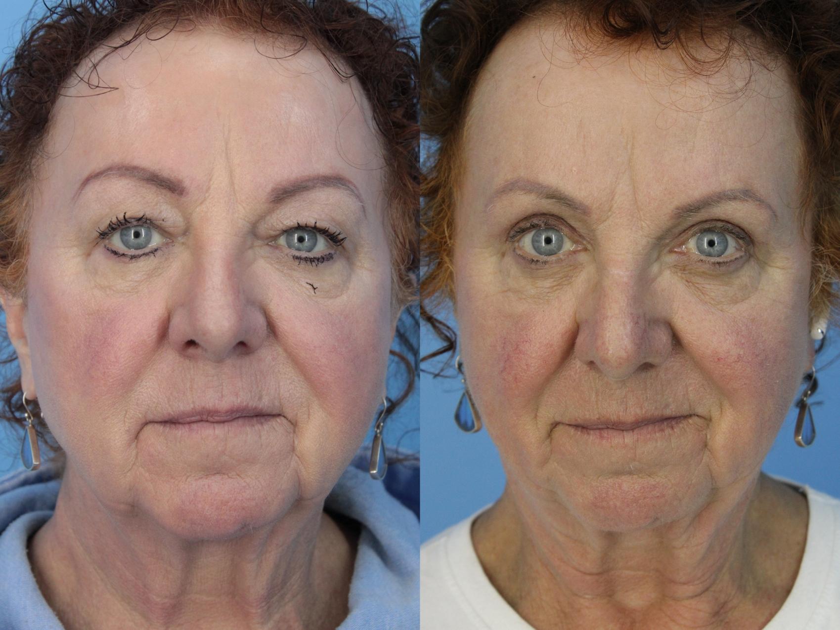 Before & After Blepharoplasty (Upper Eyelid Lift) Case 447 Front View in West Des Moines & Ames, IA